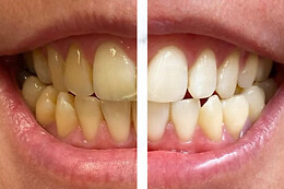 Bleaching and More